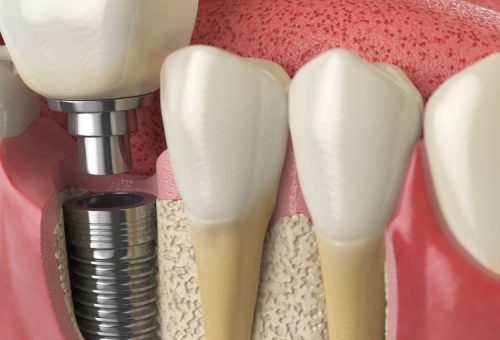Dental Implants & Their Multiple Benefits