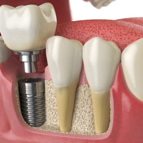 Dental Implants & Their Multiple Benefits